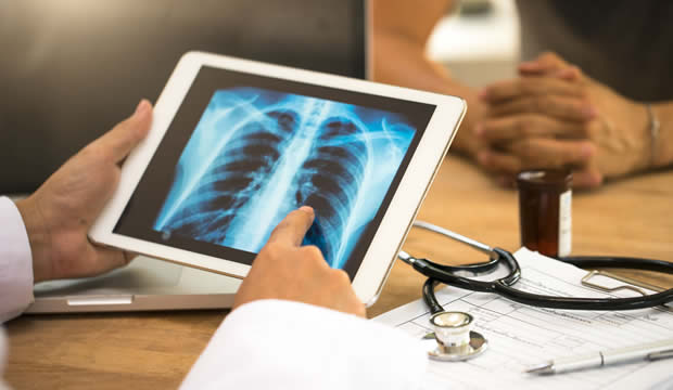 Logran identificar tumores pulmonares en etapa 1 a través de la tecnología 3D