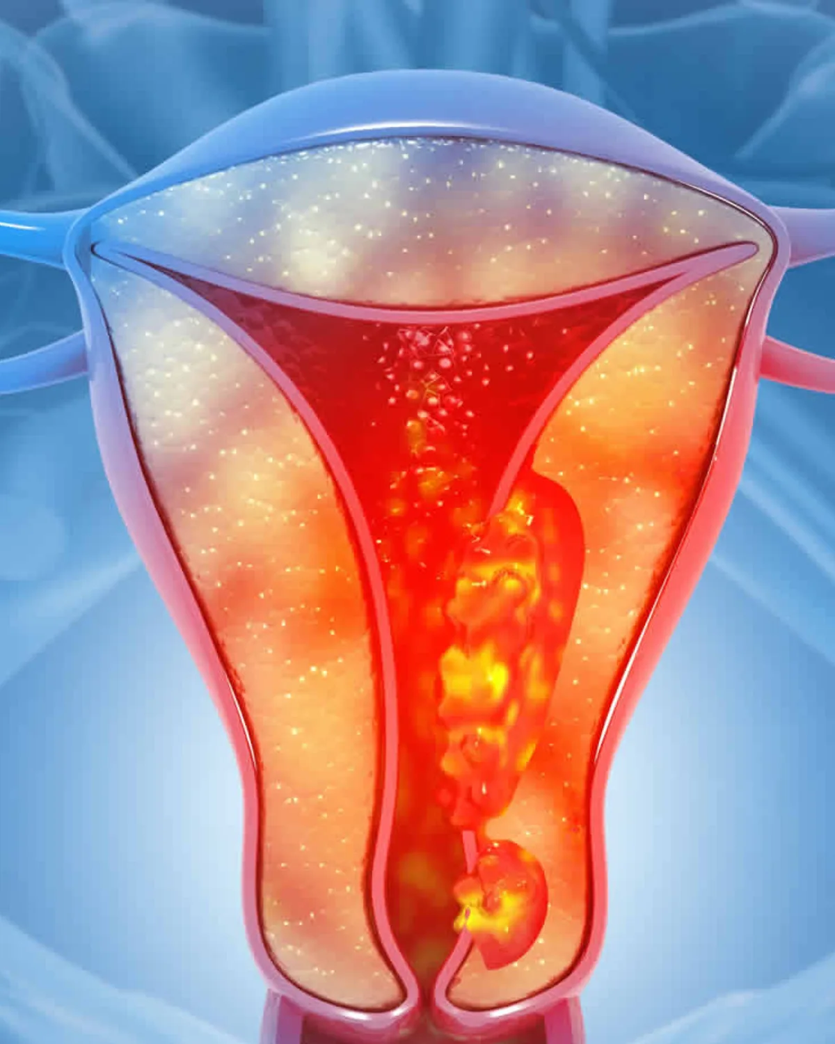 Cáncer ginecológico: tratamientos menos agresivos con la misma eficacia