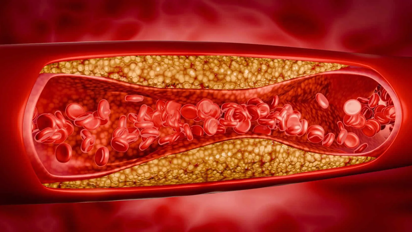 Aterosclerosis: lo que debes conocer sobre esta enfermedad prevenible y tratable